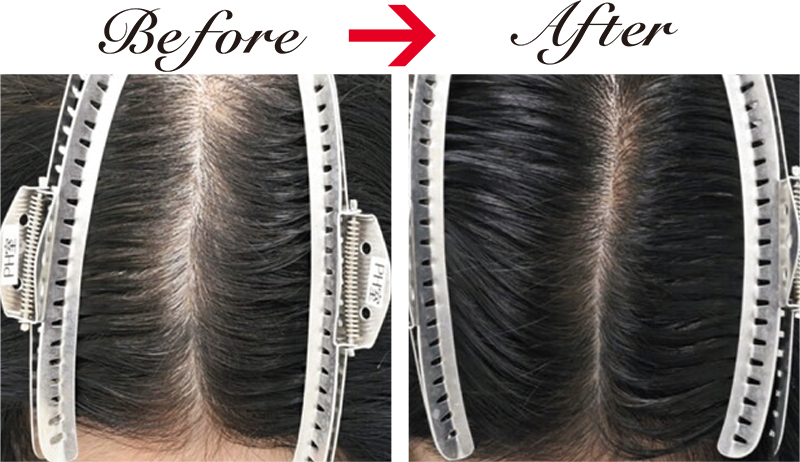 毛根再生注射、臍帯幹細胞培養上清液メソ、C-PRPメソセラピー、女性用薄毛治療薬を併用した52才女性。5か月後には頭頂部や分け目の地肌が目立たなくなった