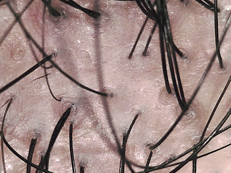 毛量が少ない頭皮