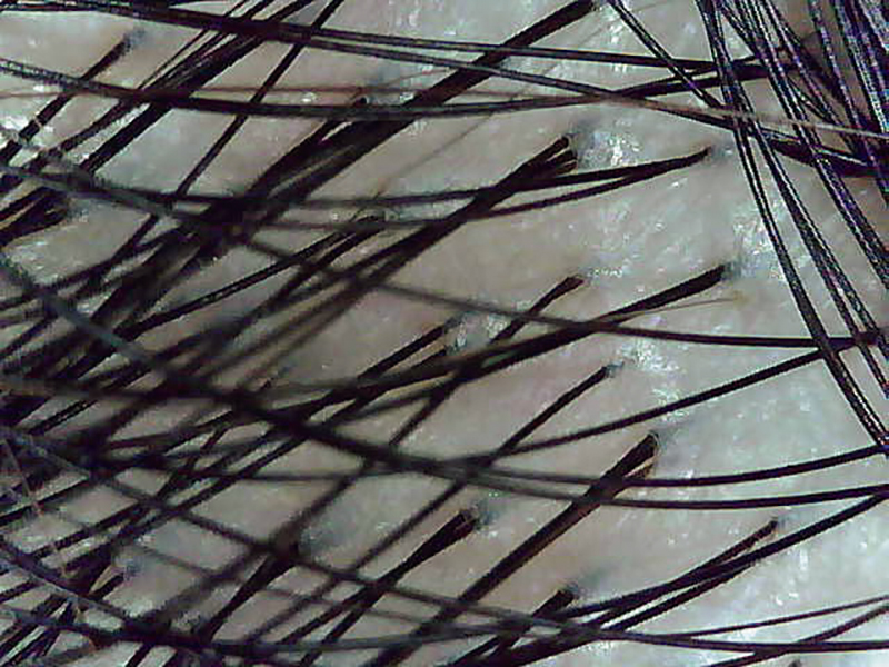 毛量が充分な頭皮