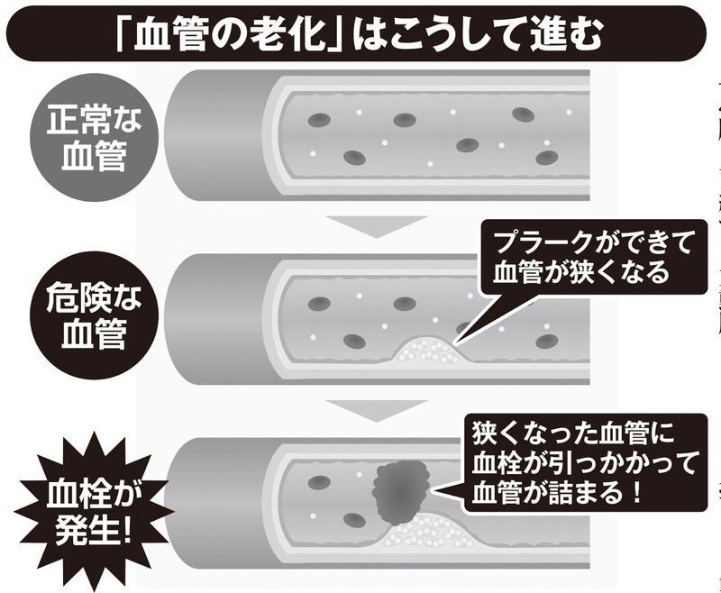 「血管の老化」はこうして進む