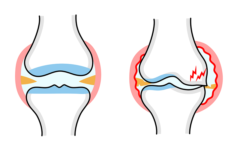 ひざ関節の軟骨がすり減った状態が悪化すると痛みにつながる