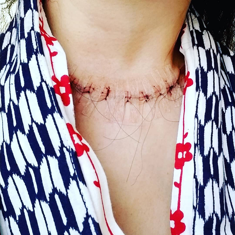 手術後の痛々しい傷痕。首のまわりを20cmほど切った