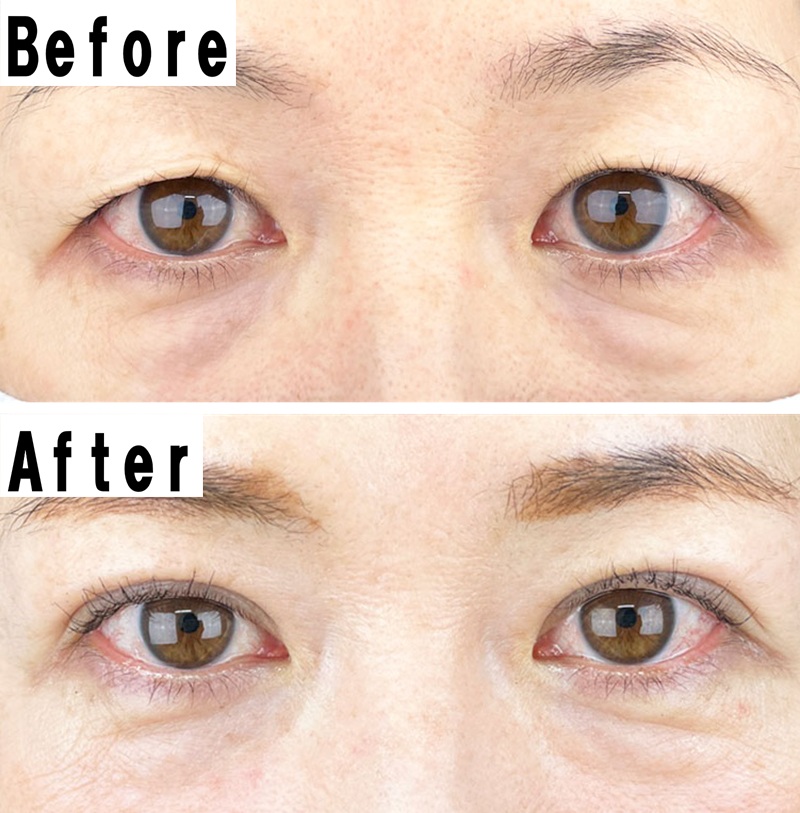 51才女性。上まぶたが被って奥二重のように見えていた目元が、二重埋没手術で華やかな二重になり目力がアップ。