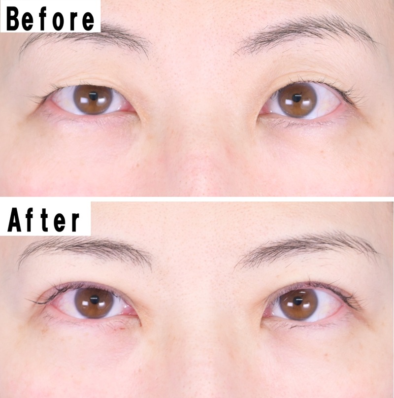 50才女性。左右の目の大きさの違いが気になる一重まぶたが、二重埋没手術によって両目の大きさも揃い自然な印象に。クイックコスメティークNeo両目９万8000円〜26万4000円（麻酔代含む）