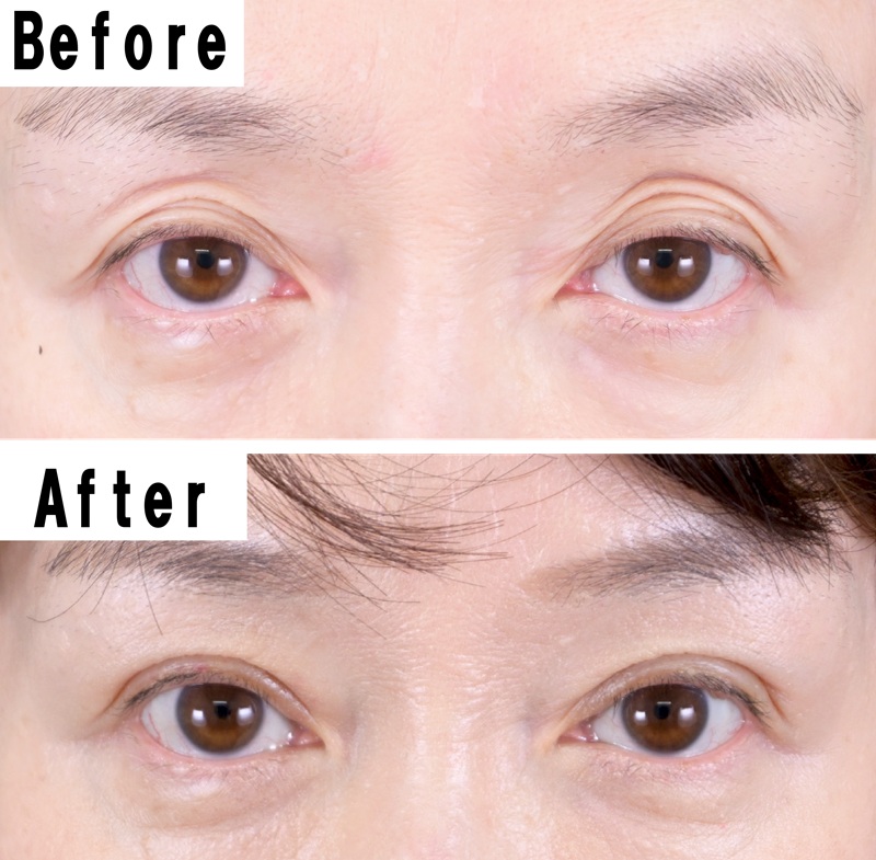 眼瞼下垂の62才女性。上まぶたの凹みが目立ち、まぶたが下がって重たい印象だったが、切らない眼瞼下垂施術によって目元が明るく目の上の凹みもなめらかになった。