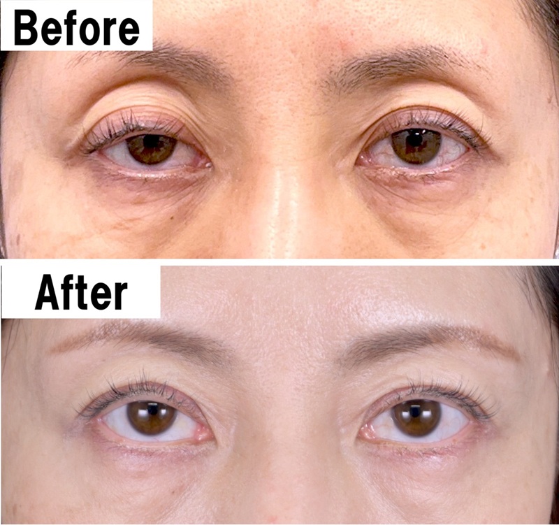 眼瞼下垂の45才女性。上まぶたが下がり黒目が半分ほどしか見えなかったが、施術後は黒目が見える範囲が広く改善。切らない眼瞼下垂両目36万8000円