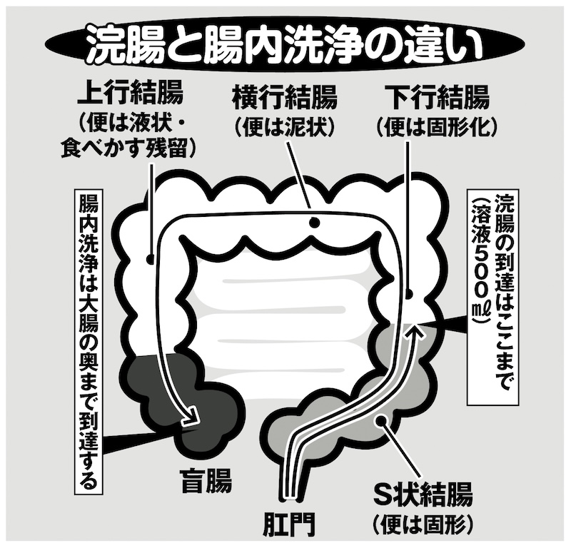 浣腸と腸内洗浄の違い