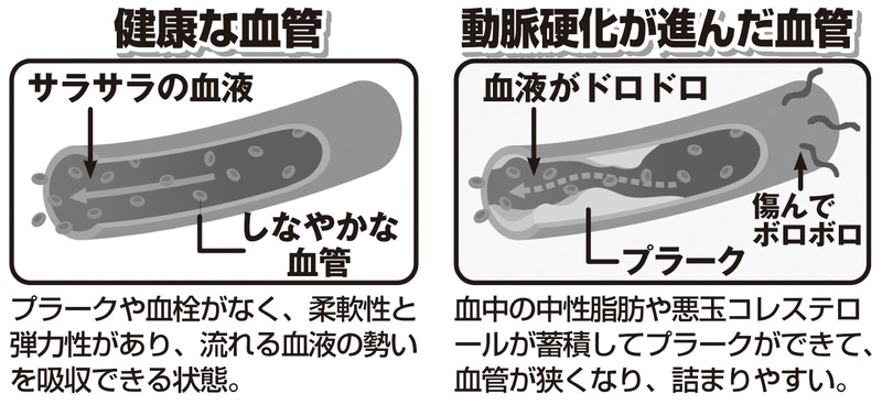 健康な血管と動脈硬化が進んだ血管