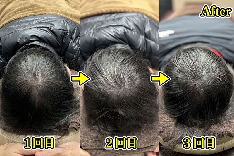 1回目から3回目の施術（写真／新宿クレアクリニック）