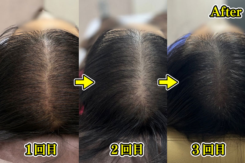 1回目から3回目の施術（写真／新宿クレアクリニック）