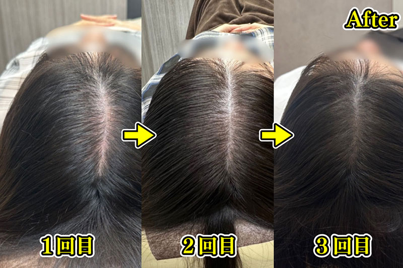 1回目から3回目の施術（写真／新宿クレアクリニック）