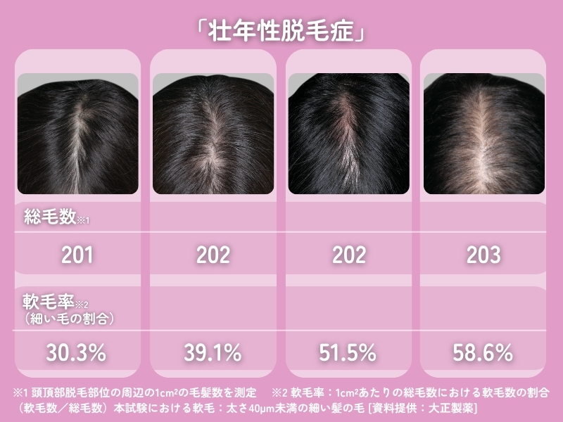 写真はすべて「壮年性脱毛症」に該当。髪の毛の本数が同じでも、細い髪が多くなると分け目がさらに目立ってくる