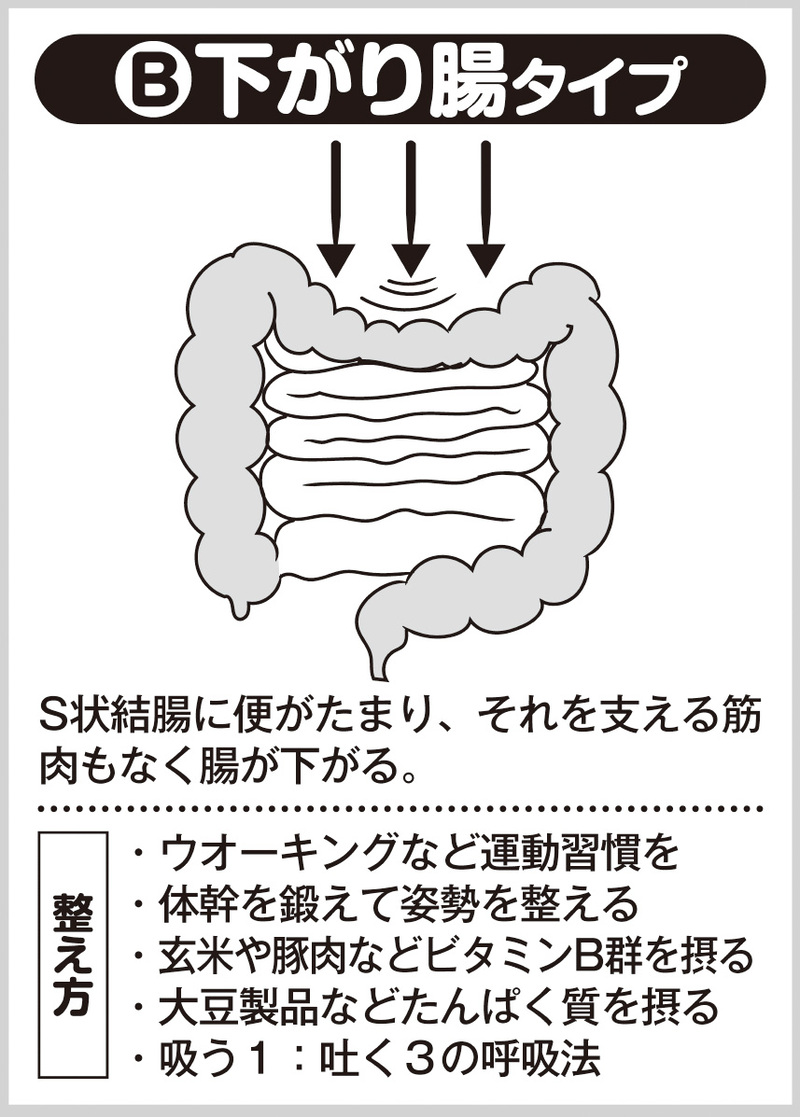 下がり腸タイプ（イラスト／藤井昌子）